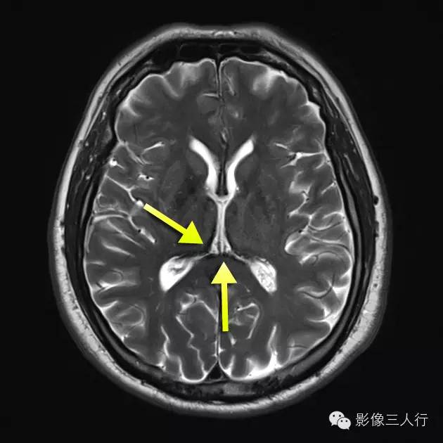 中枢神经系统铁质沉积症 中枢神经系统铁质沉积症