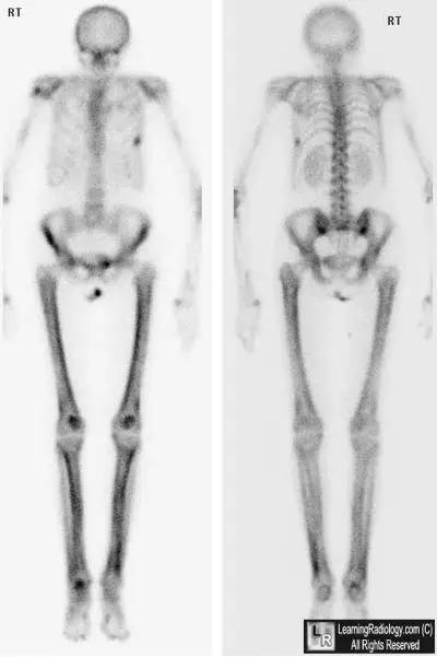 【病例】肥大性骨关节病1例影像表现