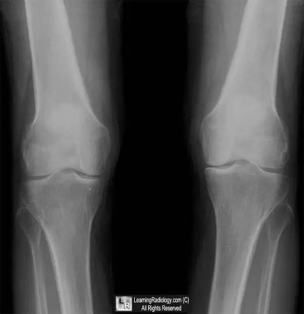 【病例】肥大性骨关节病1例影像表现 【病例】肥大性骨关节病1例影像表现