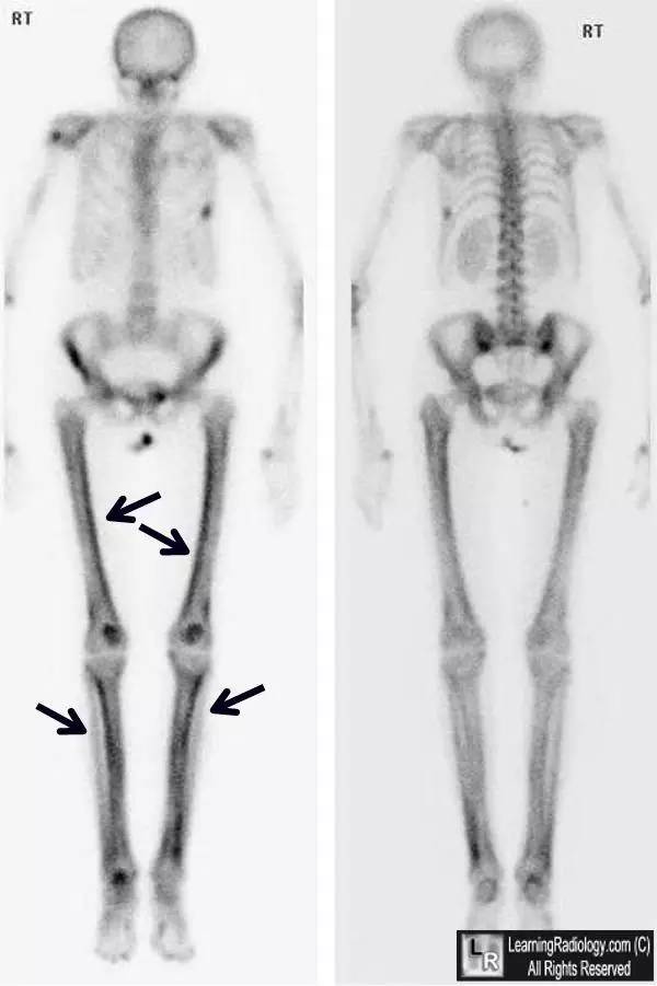【病例】肥大性骨关节病1例影像表现 【病例】肥大性骨关节病1例影像表现