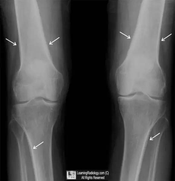 【病例】肥大性骨关节病1例影像表现 【病例】肥大性骨关节病1例影像表现