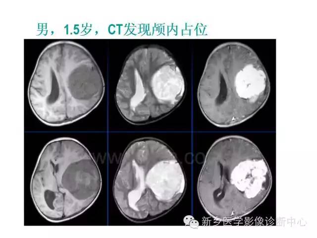 【病例】原始神经外胚层肿瘤PNET一例影像表现