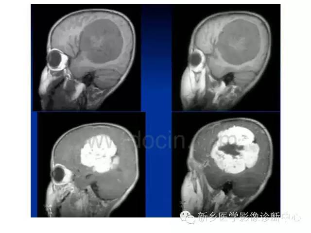 【病例】原始神经外胚层肿瘤PNET一例影像表现