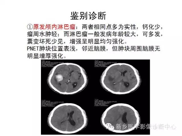 【病例】原始神经外胚层肿瘤PNET一例影像表现