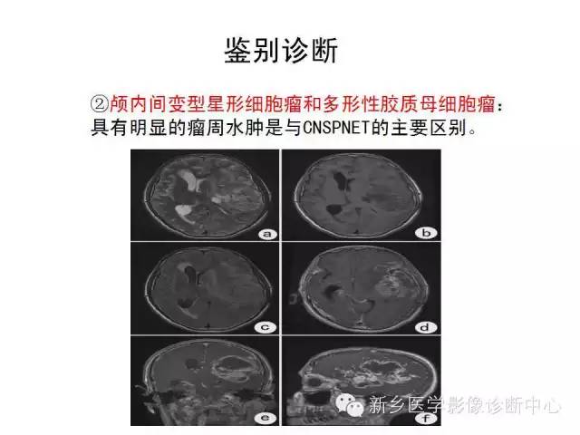【病例】原始神经外胚层肿瘤PNET一例影像表现