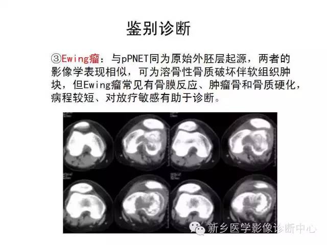 【病例】原始神经外胚层肿瘤PNET一例影像表现