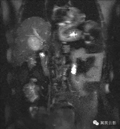 【病例】原发性肝癌1例MR影像表现