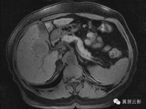 【病例】原发性肝癌1例MR影像表现 【病例】原发性肝癌1例MR影像表现