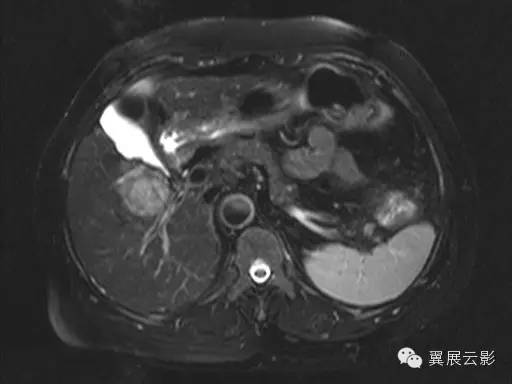 【病例】原发性肝癌1例MR影像表现 【病例】原发性肝癌1例MR影像表现