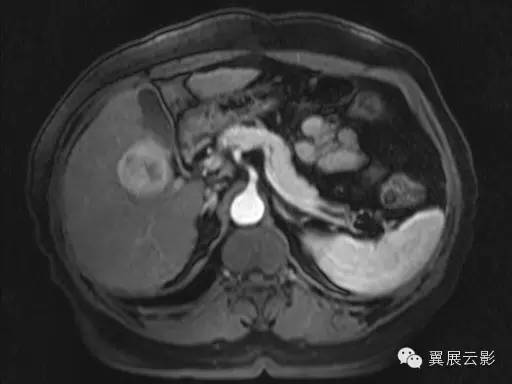 【病例】原发性肝癌1例MR影像表现 【病例】原发性肝癌1例MR影像表现