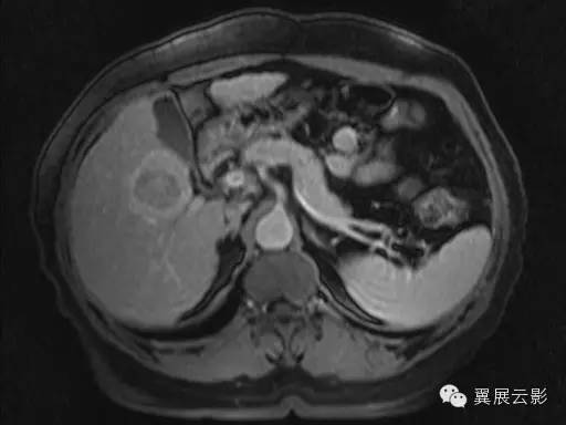 【病例】原发性肝癌1例MR影像表现 【病例】原发性肝癌1例MR影像表现