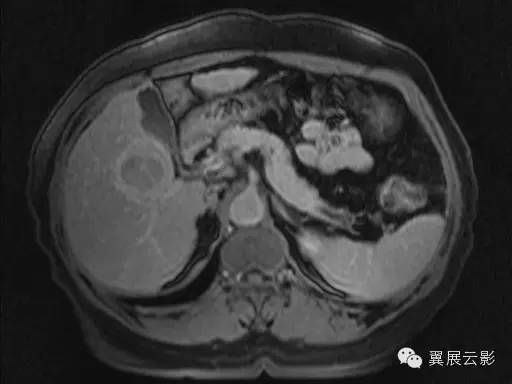 【病例】原发性肝癌1例MR影像表现 【病例】原发性肝癌1例MR影像表现