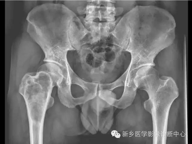 【病例】骨纤维异常增殖症1例MR影像表现