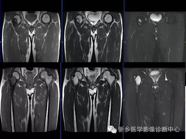 【病例】骨纤维异常增殖症1例MR影像表现
