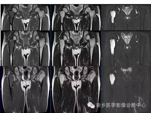 【病例】骨纤维异常增殖症1例MR影像表现