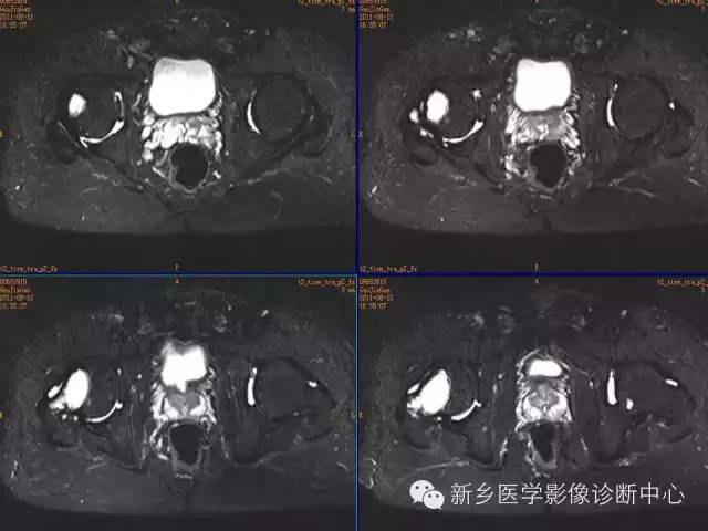 【病例】骨纤维异常增殖症1例MR影像表现