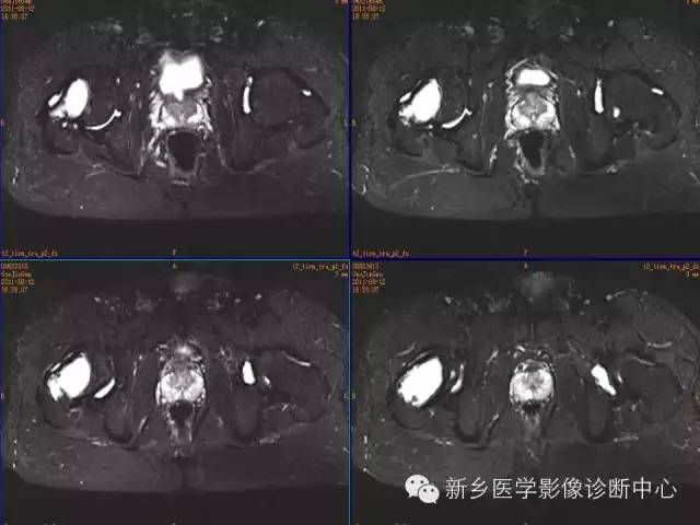 【病例】骨纤维异常增殖症1例MR影像表现