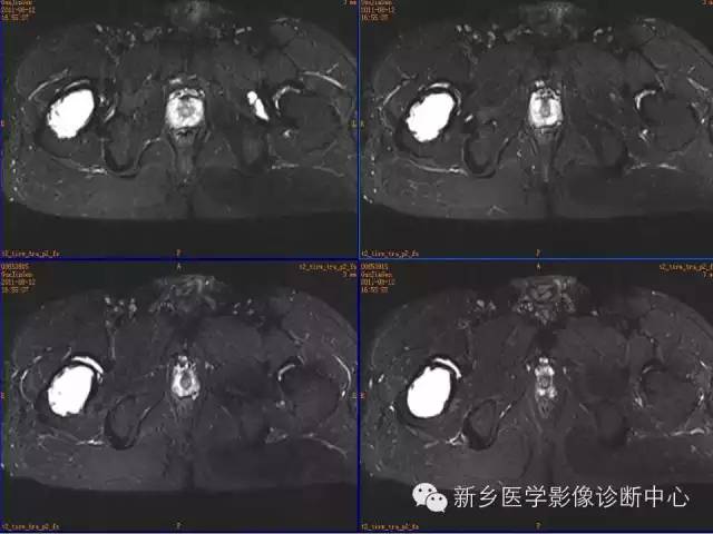 【病例】骨纤维异常增殖症1例MR影像表现