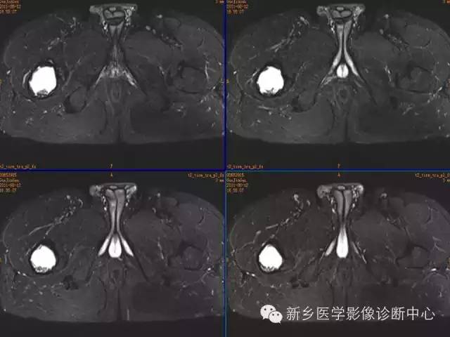 【病例】骨纤维异常增殖症1例MR影像表现