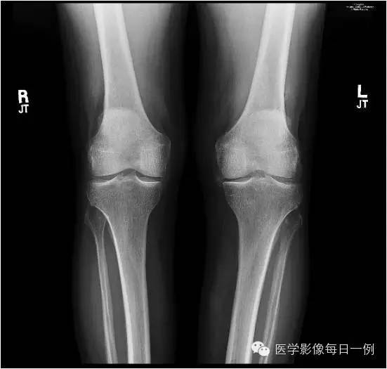 【病例】焦磷酸钙沉积病1例