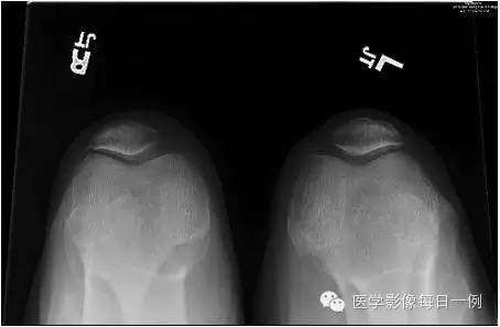 【病例】焦磷酸钙沉积病1例 【病例】焦磷酸钙沉积病1例