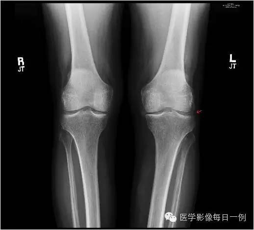 【病例】焦磷酸钙沉积病1例 【病例】焦磷酸钙沉积病1例