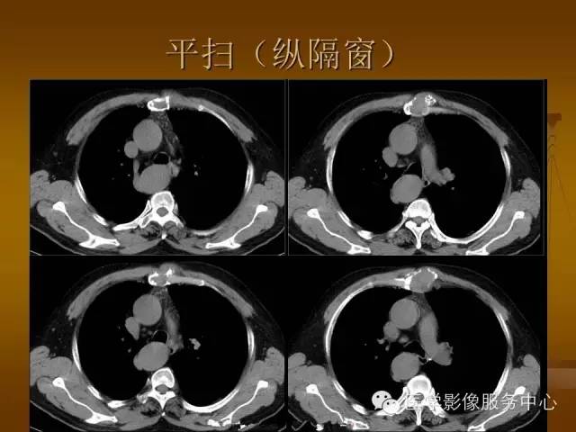 【病例】胸骨浆细胞骨髓瘤1例CT影像表现 【病例】胸骨浆细胞骨髓瘤1例CT影像表现
