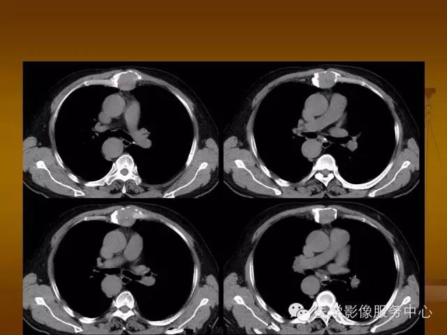 【病例】胸骨浆细胞骨髓瘤1例CT影像表现 【病例】胸骨浆细胞骨髓瘤1例CT影像表现