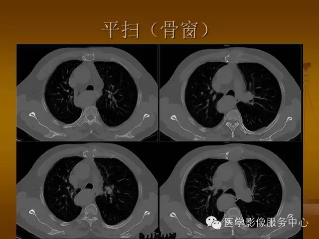 【病例】胸骨浆细胞骨髓瘤1例CT影像表现 【病例】胸骨浆细胞骨髓瘤1例CT影像表现