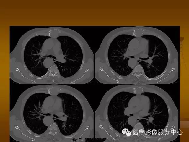 【病例】胸骨浆细胞骨髓瘤1例CT影像表现 【病例】胸骨浆细胞骨髓瘤1例CT影像表现