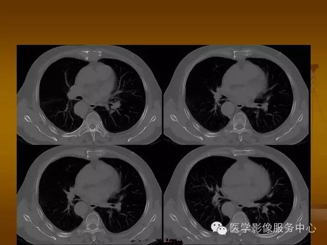 【病例】胸骨浆细胞骨髓瘤1例CT影像表现 【病例】胸骨浆细胞骨髓瘤1例CT影像表现