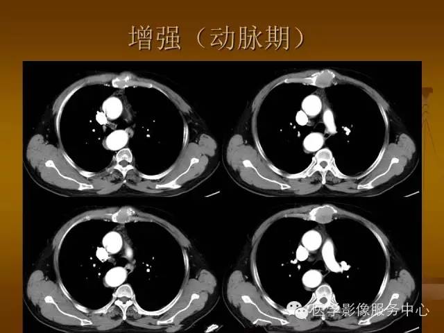 【病例】胸骨浆细胞骨髓瘤1例CT影像表现 【病例】胸骨浆细胞骨髓瘤1例CT影像表现