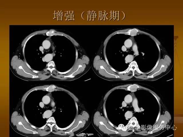 【病例】胸骨浆细胞骨髓瘤1例CT影像表现 【病例】胸骨浆细胞骨髓瘤1例CT影像表现