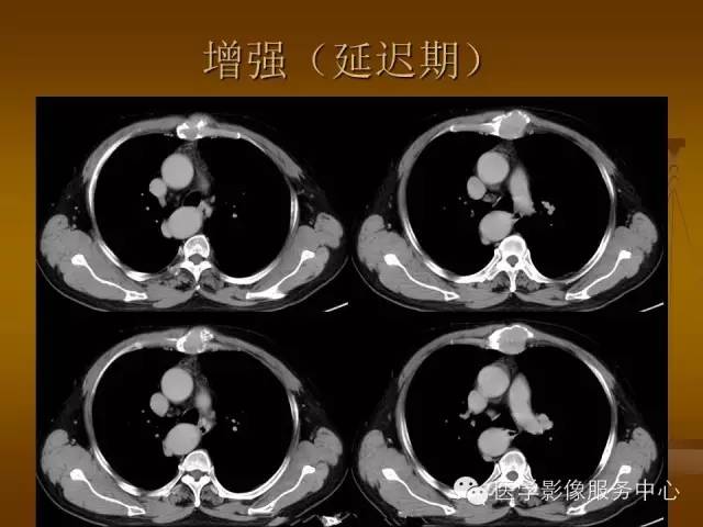 【病例】胸骨浆细胞骨髓瘤1例CT影像表现 【病例】胸骨浆细胞骨髓瘤1例CT影像表现