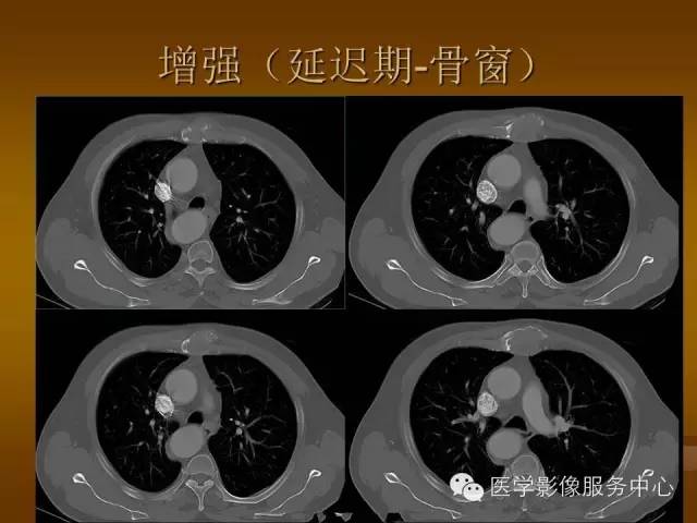 【病例】胸骨浆细胞骨髓瘤1例CT影像表现 【病例】胸骨浆细胞骨髓瘤1例CT影像表现