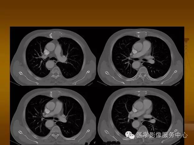 【病例】胸骨浆细胞骨髓瘤1例CT影像表现 【病例】胸骨浆细胞骨髓瘤1例CT影像表现