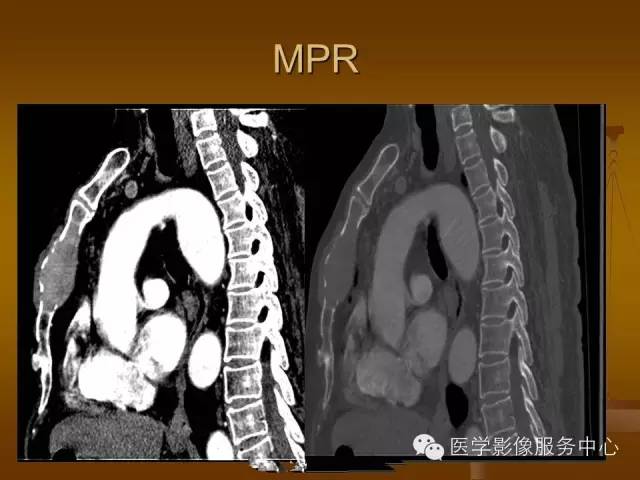 【病例】胸骨浆细胞骨髓瘤1例CT影像表现 【病例】胸骨浆细胞骨髓瘤1例CT影像表现