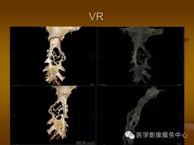 【病例】胸骨浆细胞骨髓瘤1例CT影像表现 【病例】胸骨浆细胞骨髓瘤1例CT影像表现