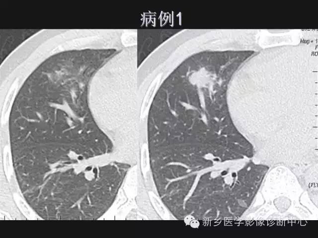 【病例】肺炎性假瘤2例影像表现与鉴别