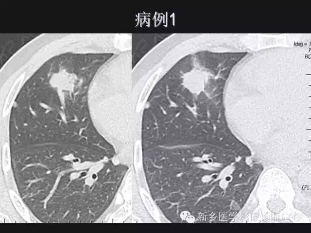 【病例】肺炎性假瘤2例影像表现与鉴别