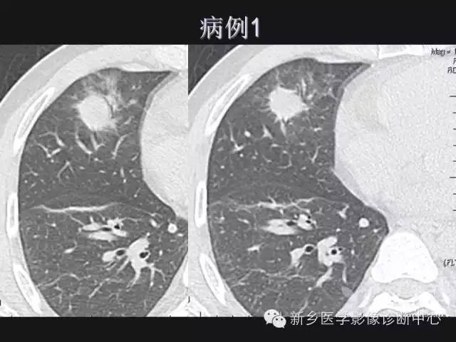 【病例】肺炎性假瘤2例影像表现与鉴别