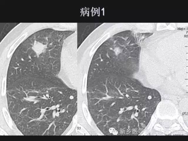 【病例】肺炎性假瘤2例影像表现与鉴别