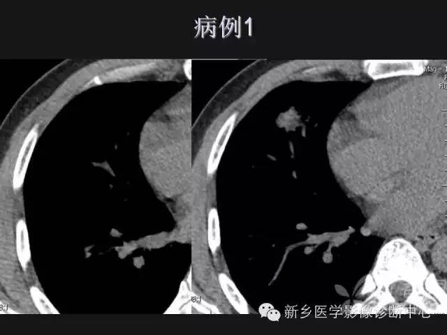 【病例】肺炎性假瘤2例影像表现与鉴别