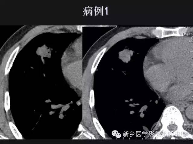 【病例】肺炎性假瘤2例影像表现与鉴别