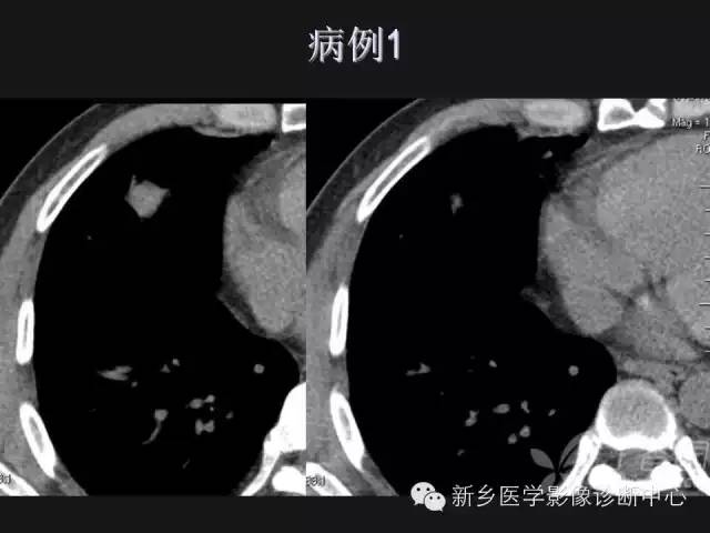 【病例】肺炎性假瘤2例影像表现与鉴别