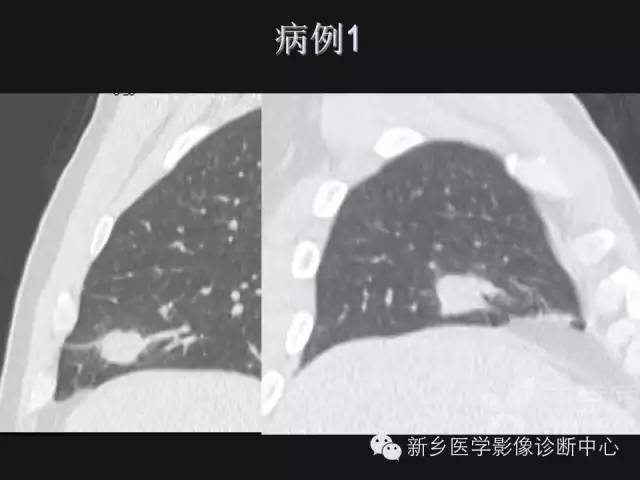 【病例】肺炎性假瘤2例影像表现与鉴别
