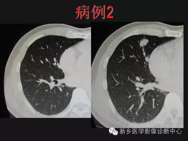 【病例】肺炎性假瘤2例影像表现与鉴别