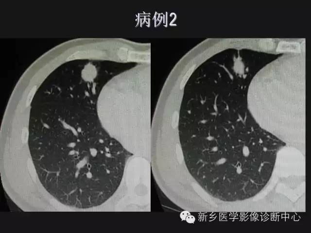 【病例】肺炎性假瘤2例影像表现与鉴别