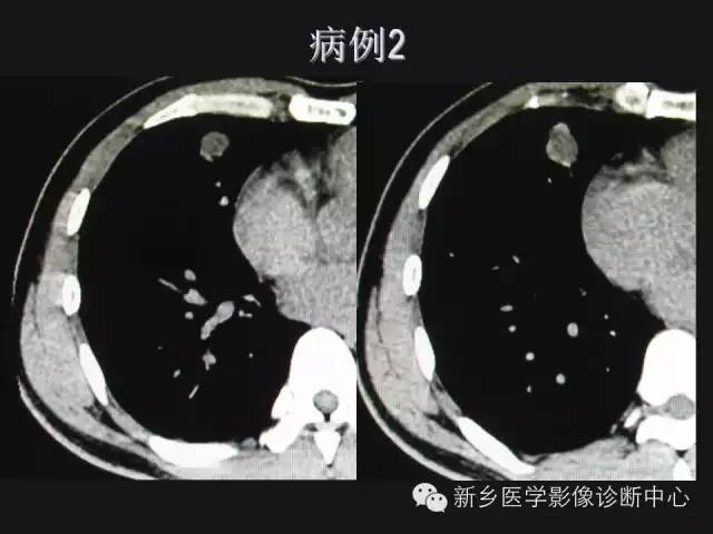 【病例】肺炎性假瘤2例影像表现与鉴别