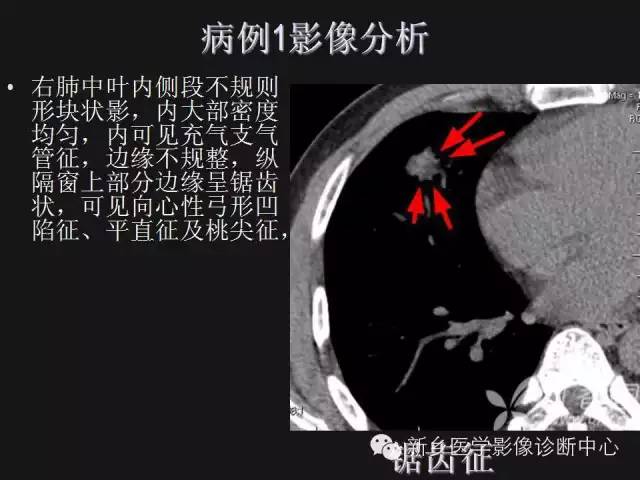 【病例】肺炎性假瘤2例影像表现与鉴别